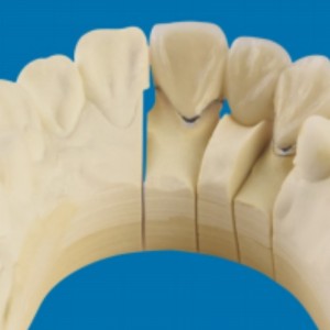 Metal-Zęby porcelanowe